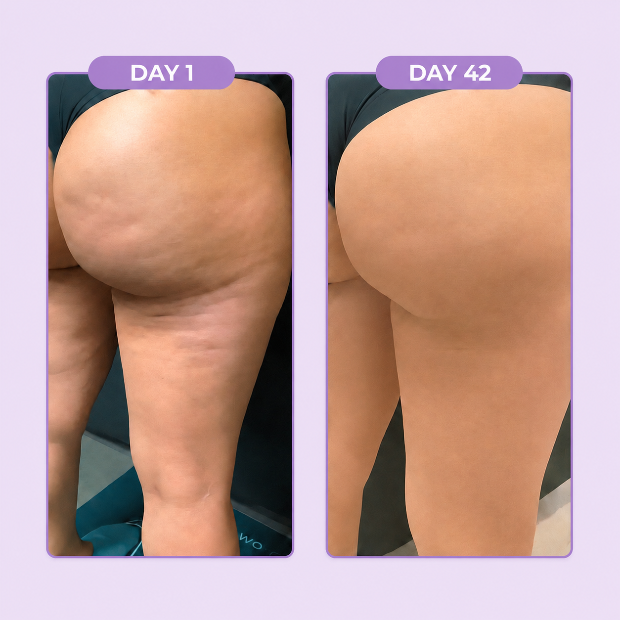 CUPIA™ Anti-Cellulite Massager